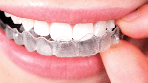 Types of Braces, Dr. Gail Schupak