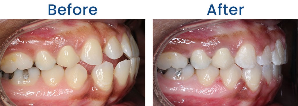Before and After Dr. Doug Orthodontics PLLC in Rockville Centre NY