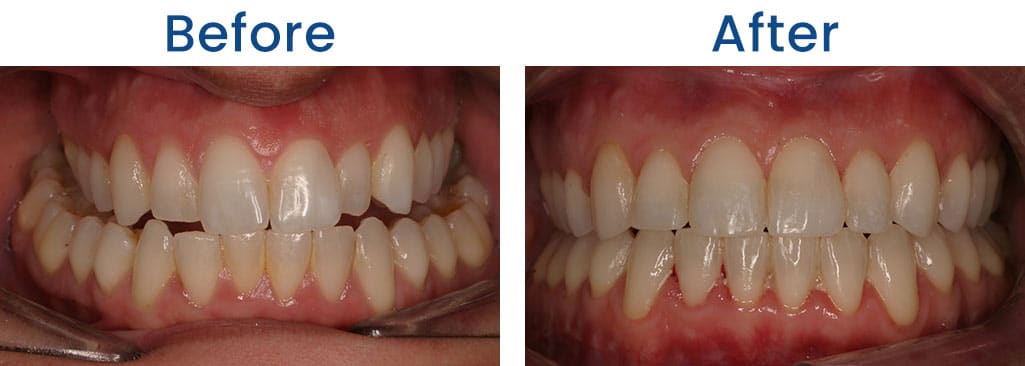 Before and After Dr. Doug Orthodontics PLLC in Rockville Centre NY