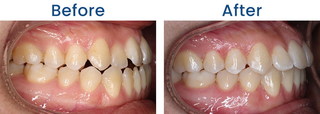Before and After Dr. Doug Orthodontics PLLC in Rockville Centre NY