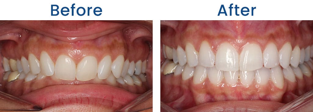 Before and After Dr. Doug Orthodontics PLLC in Rockville Centre NY
