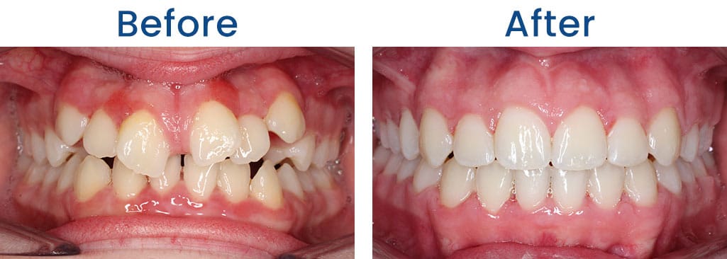Before and After Dr. Doug Orthodontics PLLC in Rockville Centre NY