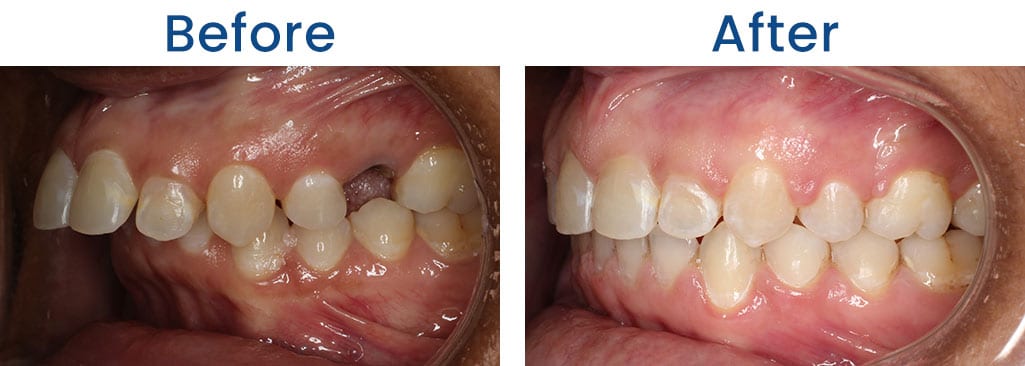 Before and After Dr. Doug Orthodontics PLLC in Rockville Centre NY