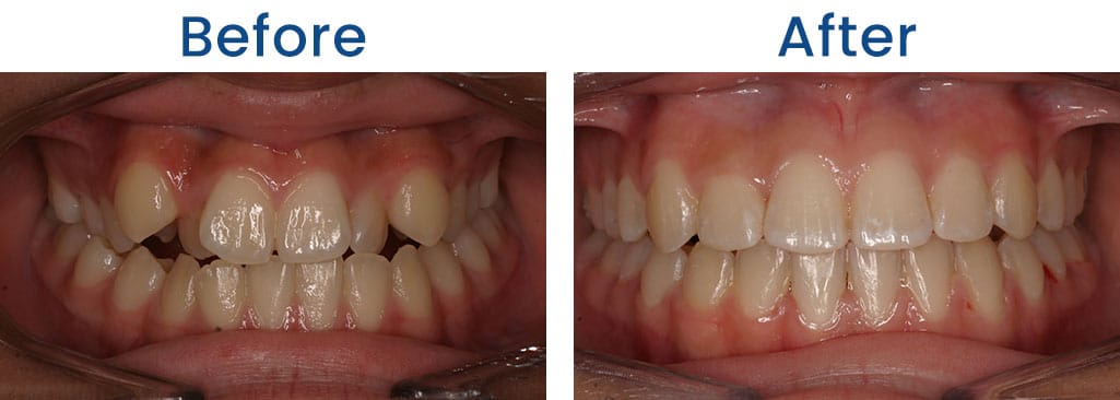 Before and After Dr. Doug Orthodontics PLLC in Rockville Centre NY