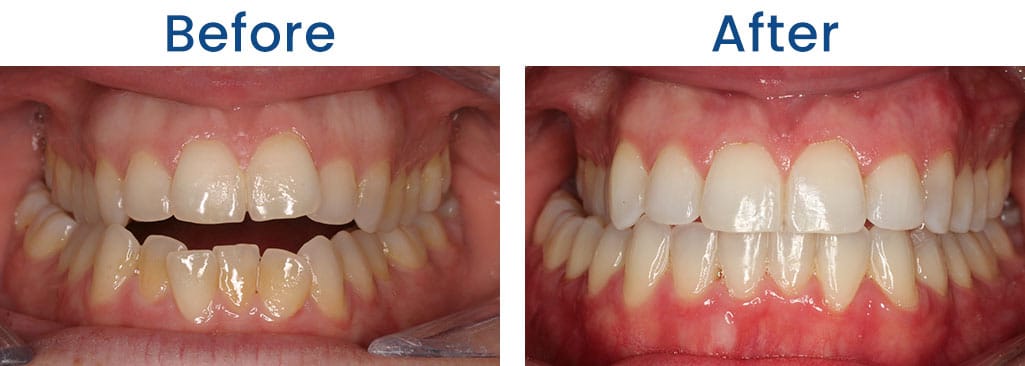 Before and After Dr. Doug Orthodontics PLLC in Rockville Centre NY