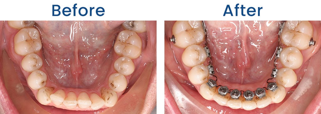 Before and After Dr. Doug Orthodontics PLLC in Rockville Centre NY