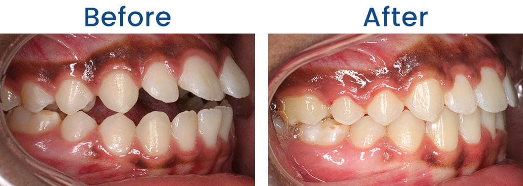Before and After Dr. Doug Orthodontics PLLC in Rockville Centre NY