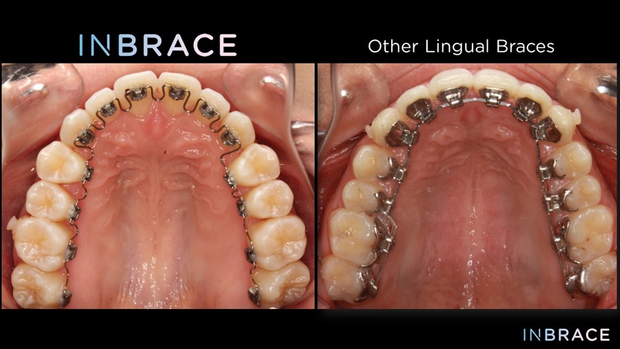 Ceramic Braces vs. Invisalign, NYC Smile Design