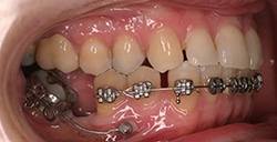 TADS Image 1 Great Neck Orthodontics