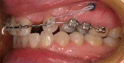 TADS Image 2 Great Neck Orthodontics