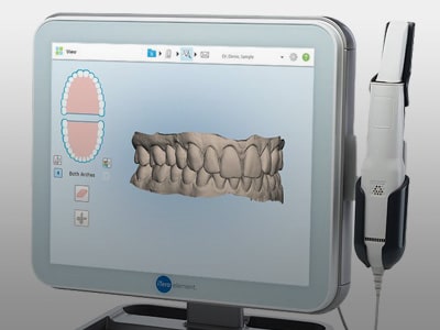 Orthodontic 3D mapping software on monitor | Dr. Doug Orthodontics
