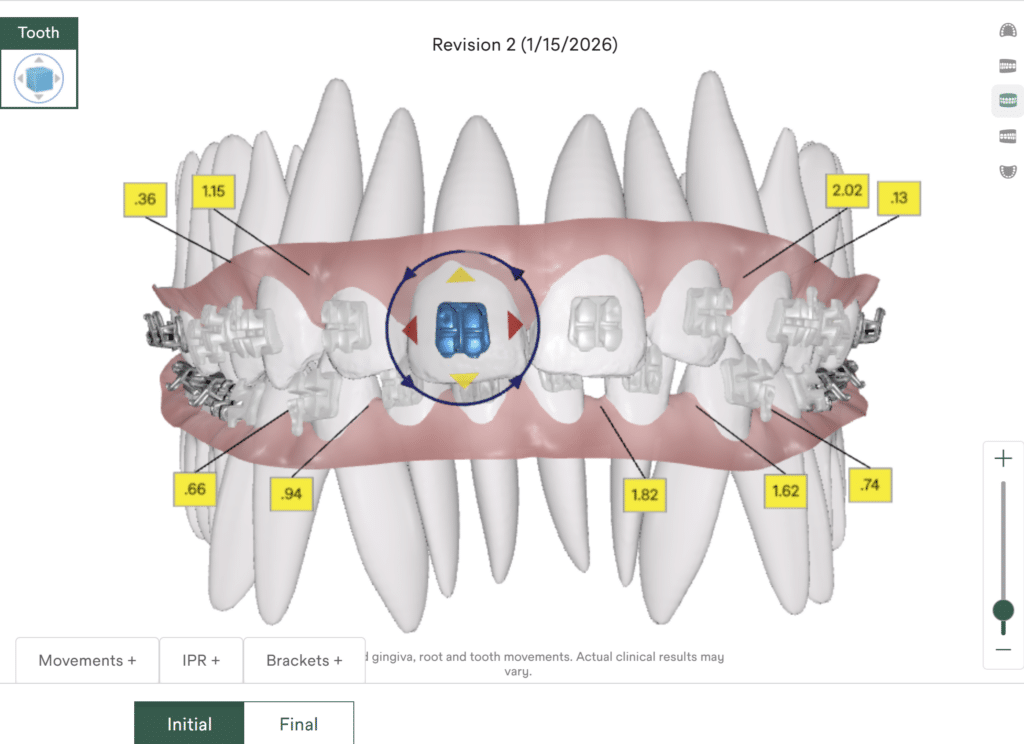3D digital tooth mapping software | Dr. Doug Orthodontics