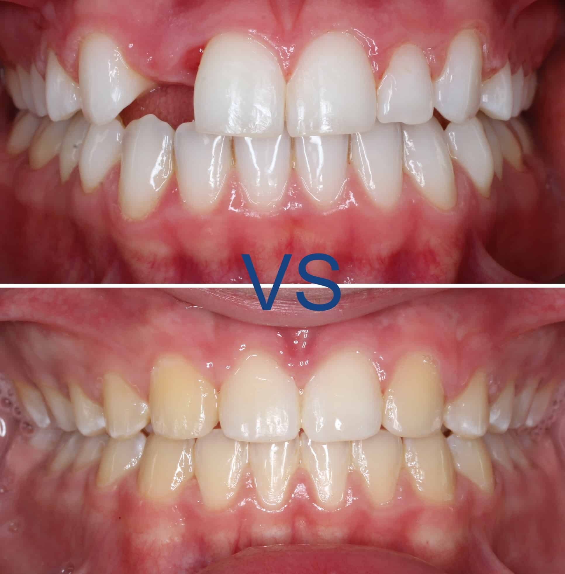 Before and after smile transformation comparison | Dr. Doug Orthodontics