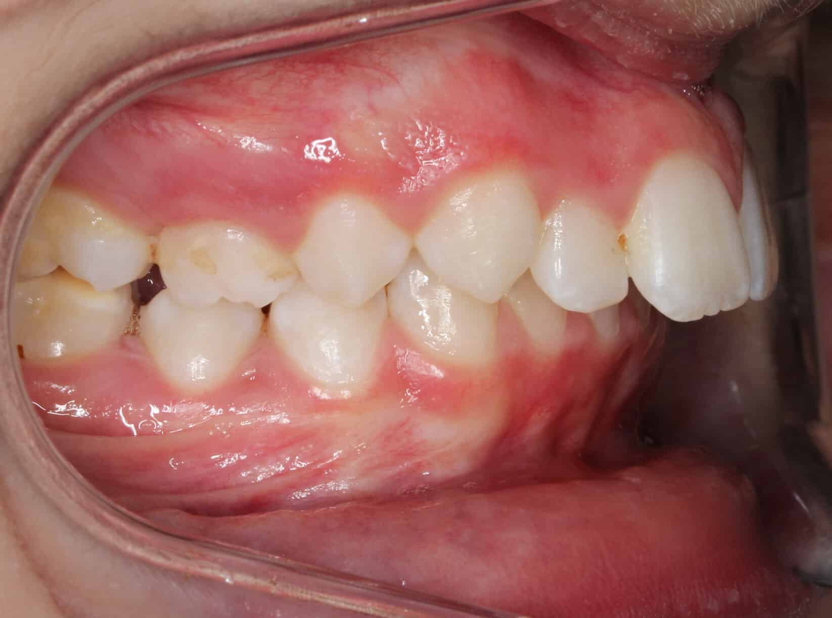 Side view of bite alignment | Dr. Doug Orthodontics
